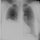 Diaphragmatic hernia, Morgagni hernia: X-ray - Plain radiograph